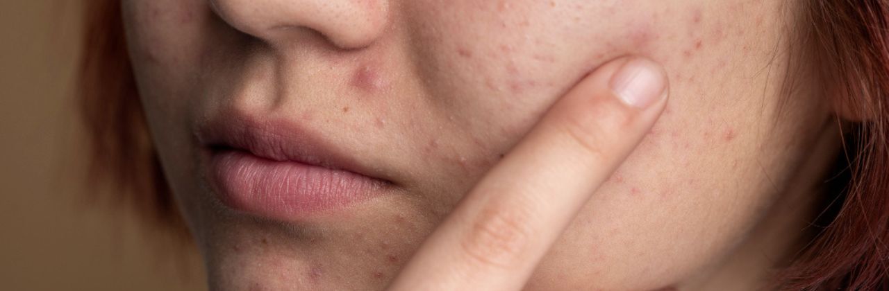 Acne skin care: the right routine and the most common mistakes